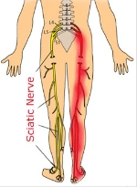 sciatica
