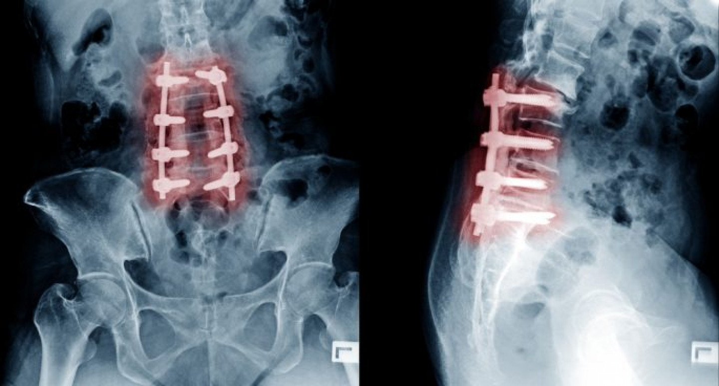 Spinal-Fusion